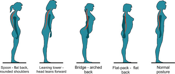 你是“勺形”還是“橋形”？站姿決定背痛與否